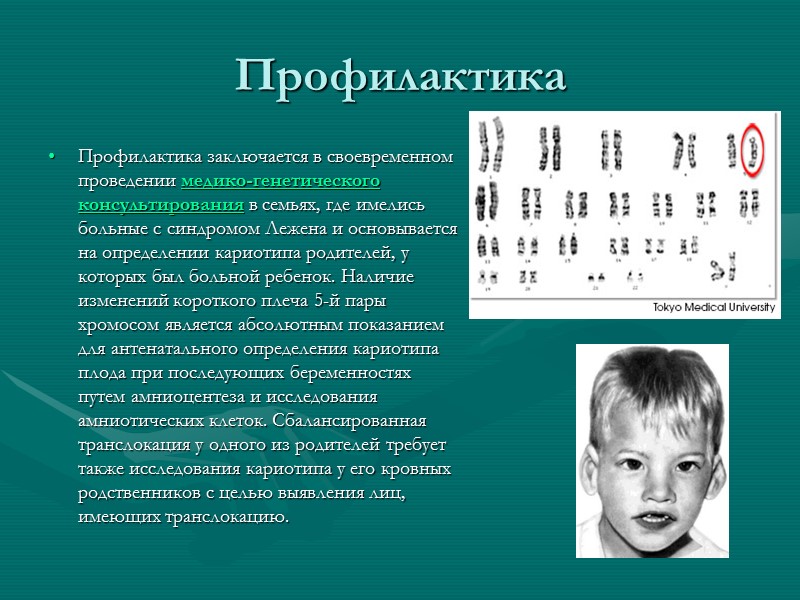 Профилактика Профилактика заключается в своевременном проведении медико-генетического консультирования в семьях, где имелись больные с